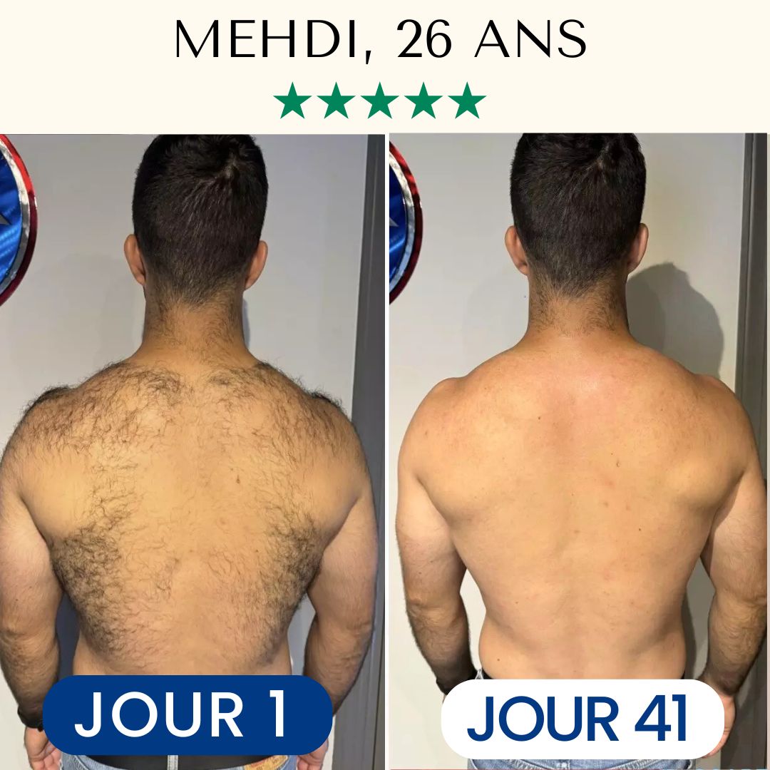 Épilation Définitive Professionnelle Lumière Pulsée IPL™ pour Homme