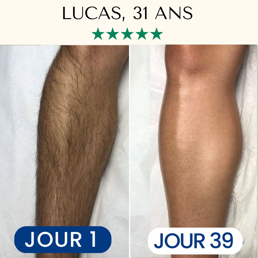 Épilation Définitive Professionnelle Lumière Pulsée IPL™ pour Homme