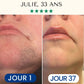 Épilation Définitive Professionnelle à la Lumière Pulsée IPL™
