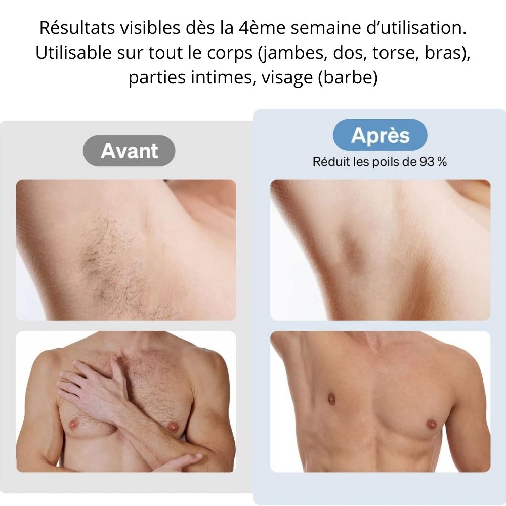 Épilation Définitive Professionnelle Lumière Pulsée IPL™ pour Homme