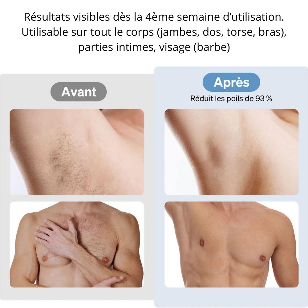 Epilation solution radicale lumière pulsée pour homme